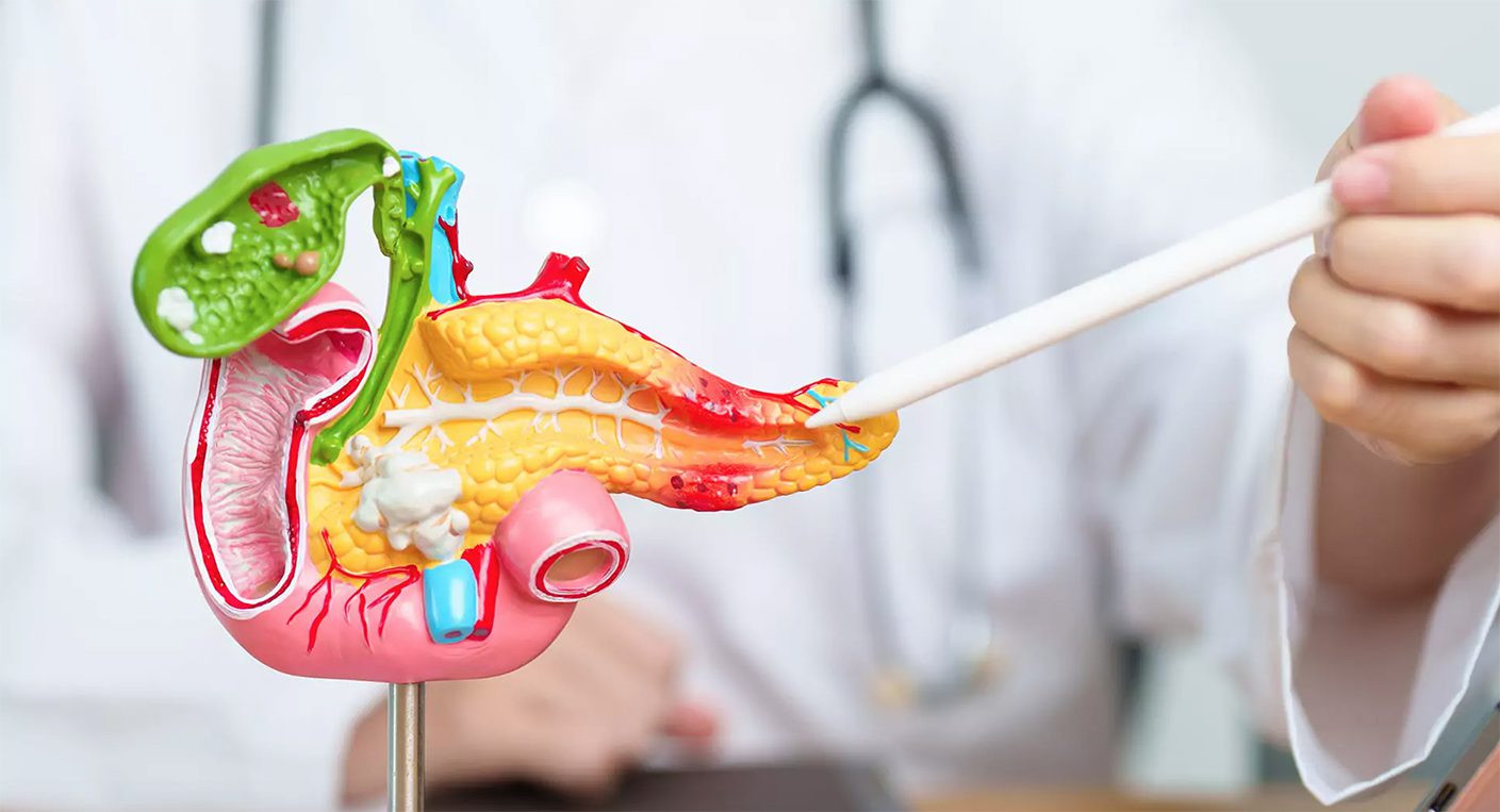 Une nouvelle trithérapie ouvre des perspectives contre le cancer du pancréas